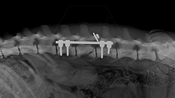 The best method to stabilize the spine is our patented SOP-LC system.