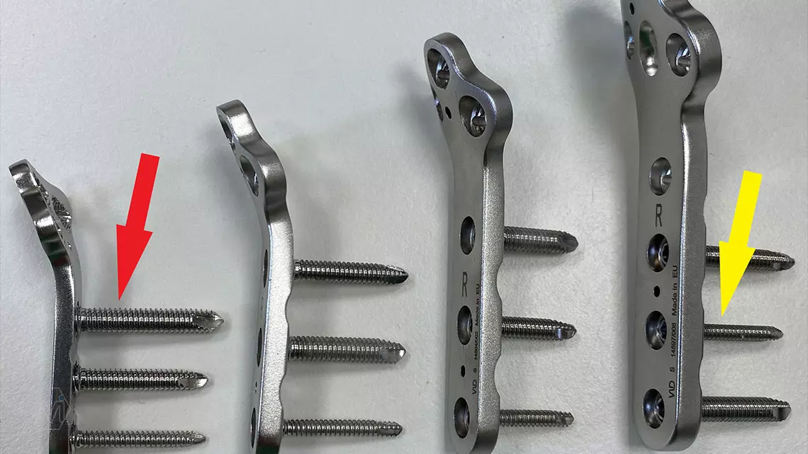 1 type of hole, 1 set of screws, 4 different sized plates, this is a family of polyaxial precontuared locking plates!