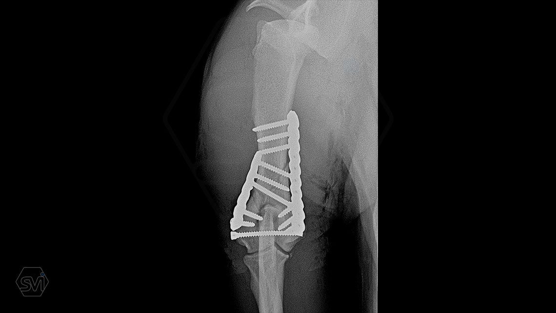What used to be a nightmare type of surgery is slowly becoming my favorite: the humerus distal Y fracture