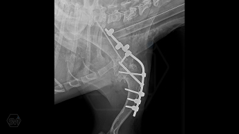 If it's shoulder arthrodesis, then SOP-LC!